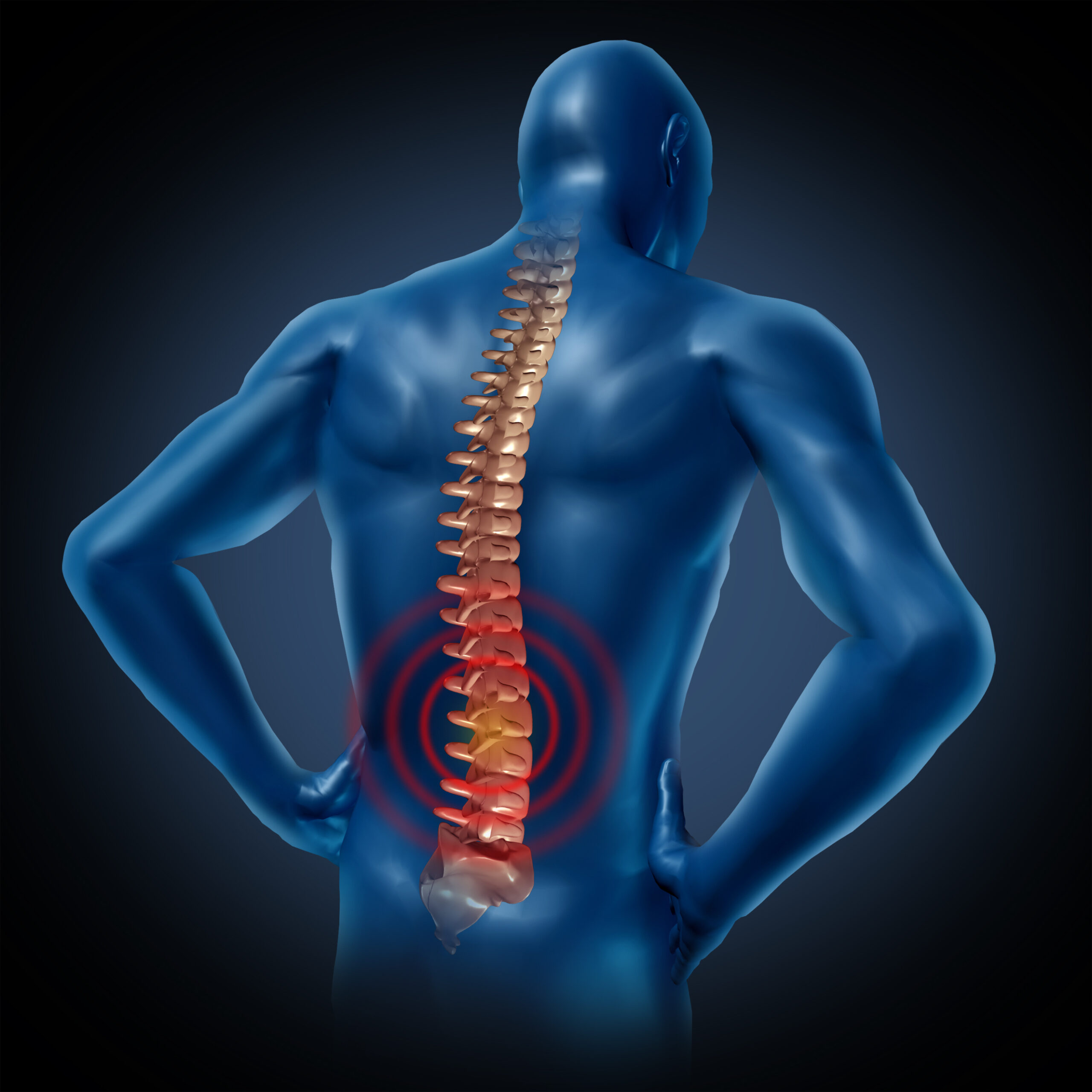 Illustration of a human back with the spine highlighted and pain in the lower lumbar discs